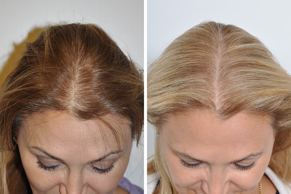 Hair Transplant Istanbul – Expert Care for a Fuller Head of Hair