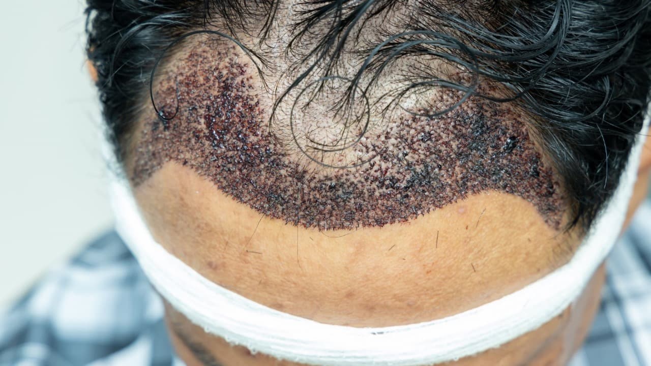 Hair Transplant UK – Restoring Confidence Across the Nation
