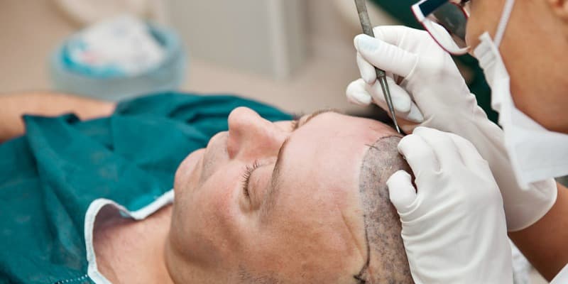 Hair Transplant Turkey: Affordable Excellence for Every Budget