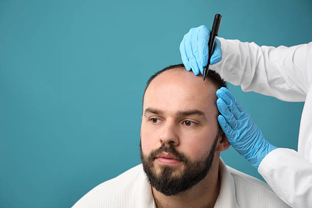 Hair Transplant Price Packages: What Is Included?